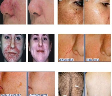 3 handles high performance IPL hair removal machine for best hair removal results