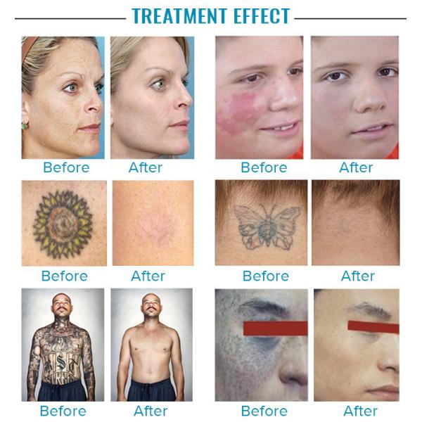 1064nm 532nm Laser Machine Pigment Removal Sun Spots Laser Treatment Device