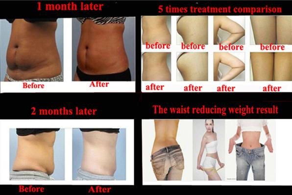 Professional Medical Fat Freeze Ultrasound Machine/ Vacuum Multipolar RF Slimming Device