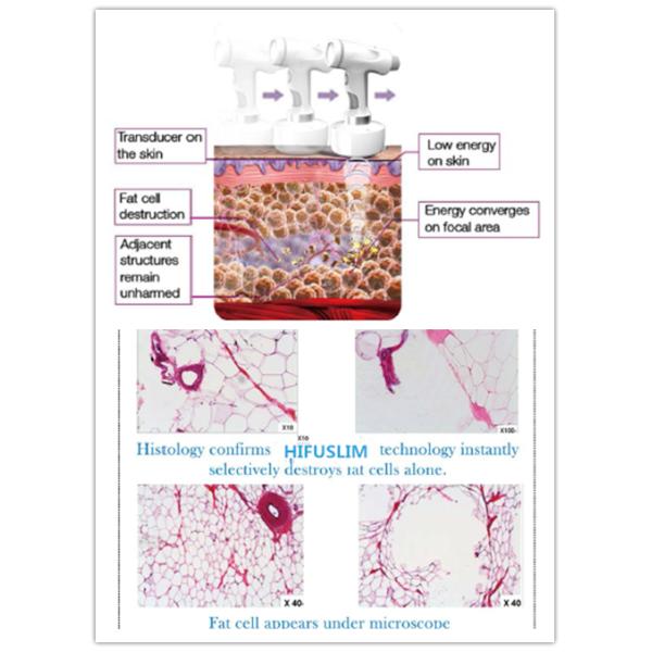 HIFU ultrasonic fat cavitation for fat loss hifu slimming machine