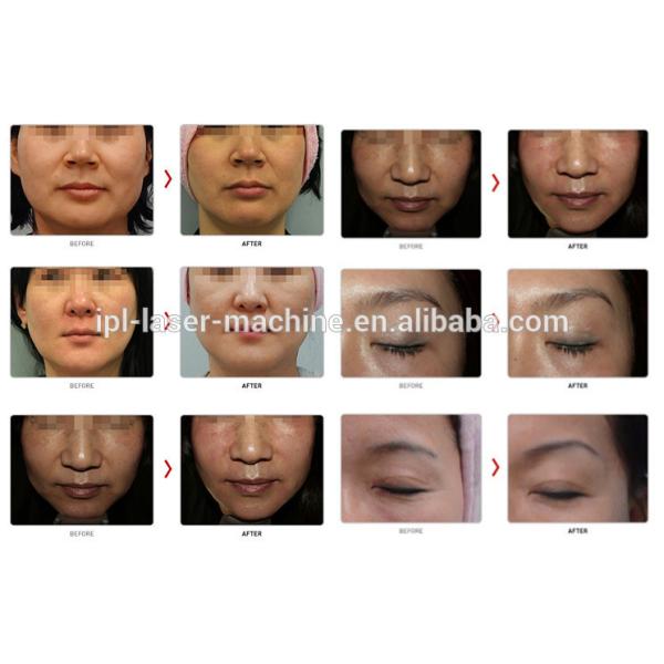 New type Anti-aging machine / Hifu facelift beauty machine for salon use
