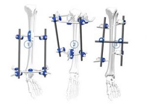 China Flexible Orthopedic Trauma Implants Tibial Plateau Frame External Fixation on sale