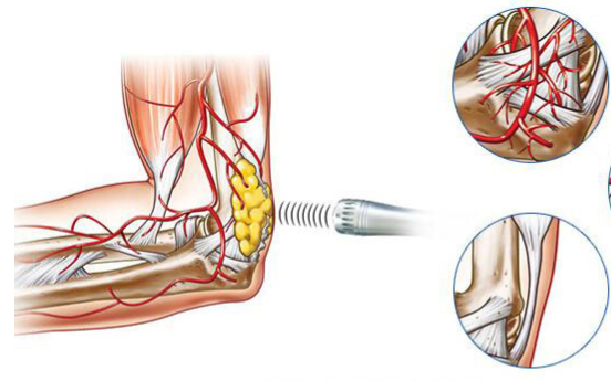 Deep Super Facial Stimulation 1000mj Physical Therapy Shock Wave Machine