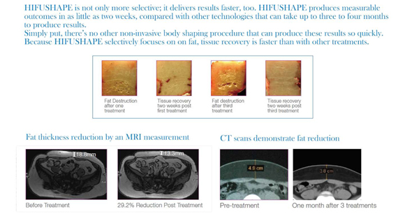 portable hifu shape ultrasound fat removal machine focused ultrasound liposuction
