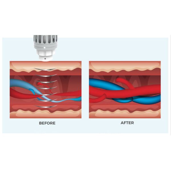 Shock Wave Therapy Machine Portable ED(Sexual Erectile Dysfunction) Electric Muscle Stimulation Treatment ESWT Equipment